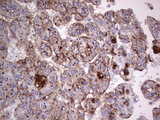 ASPA Antibody - IHC of paraffin-embedded Carcinoma of Human liver tissue using anti-ASPA mouse monoclonal antibody. (Heat-induced epitope retrieval by 1 mM EDTA in 10mM Tris, pH8.5, 120°C for 3min).