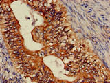 ASTN2 Antibody - Immunohistochemistry of paraffin-embedded human colon cancer using ASTN2 Antibody at dilution of 1:100