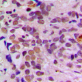 ATF1 Antibody - Immunohistochemical analysis of ATF1 staining in human breast cancer formalin fixed paraffin embedded tissue section. The section was pre-treated using heat mediated antigen retrieval with sodium citrate buffer (pH 6.0). The section was then incubated with the antibody at room temperature and detected using an HRP conjugated compact polymer system. DAB was used as the chromogen. The section was then counterstained with hematoxylin and mounted with DPX.