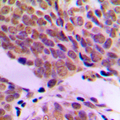 ATF2 Antibody - Immunohistochemical analysis of ATF2 staining in human breast cancer formalin fixed paraffin embedded tissue section. The section was pre-treated using heat mediated antigen retrieval with sodium citrate buffer (pH 6.0). The section was then incubated with the antibody at room temperature and detected using an HRP conjugated compact polymer system. DAB was used as the chromogen. The section was then counterstained with hematoxylin and mounted with DPX.
