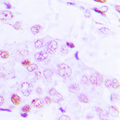 ATF2 Antibody - Immunohistochemical analysis of ATF2 (pT69) staining in human lung cancer formalin fixed paraffin embedded tissue section. The section was pre-treated using heat mediated antigen retrieval with sodium citrate buffer (pH 6.0). The section was then incubated with the antibody at room temperature and detected using an HRP conjugated compact polymer system. DAB was used as the chromogen. The section was then counterstained with hematoxylin and mounted with DPX.
