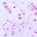 ATF3 Antibody - Immunohistochemical analysis of ATF3 staining in human lung cancer formalin fixed paraffin embedded tissue section. The section was pre-treated using heat mediated antigen retrieval with sodium citrate buffer (pH 6.0). The section was then incubated with the antibody at room temperature and detected using an HRP conjugated compact polymer system. DAB was used as the chromogen. The section was then counterstained with hematoxylin and mounted with DPX.