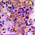 ATF4 Antibody - Immunohistochemical analysis of ATF4 (pS245) staining in human breast cancer formalin fixed paraffin embedded tissue section. The section was pre-treated using heat mediated antigen retrieval with sodium citrate buffer (pH 6.0). The section was then incubated with the antibody at room temperature and detected using an HRP conjugated compact polymer system. DAB was used as the chromogen. The section was then counterstained with hematoxylin and mounted with DPX.