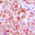 ATF5 Antibody - Immunohistochemical analysis of ATF5 staining in human prostate cancer formalin fixed paraffin embedded tissue section. The section was pre-treated using heat mediated antigen retrieval with sodium citrate buffer (pH 6.0). The section was then incubated with the antibody at room temperature and detected using an HRP conjugated compact polymer system. DAB was used as the chromogen. The section was then counterstained with hematoxylin and mounted with DPX. w
