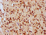 ATG16L2 Antibody - Immunohistochemistry of paraffin-embedded human gastric cancer using ATG16L2 Antibody at dilution of 1:100