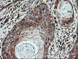 ATG3 Antibody - IHC of paraffin-embedded Carcinoma of Human bladder tissue using anti-ATG3 mouse monoclonal antibody. (Heat-induced epitope retrieval by 10mM citric buffer, pH6.0, 100C for 10min).