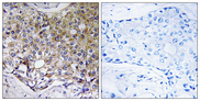 ATG4A Antibody - Immunohistochemistry analysis of paraffin-embedded human breast carcinoma tissue, using ATG4A Antibody. The picture on the right is blocked with the synthesized peptide.