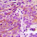 ATG4A Antibody - Immunohistochemical analysis of ATG4A staining in human breast cancer formalin fixed paraffin embedded tissue section. The section was pre-treated using heat mediated antigen retrieval with sodium citrate buffer (pH 6.0). The section was then incubated with the antibody at room temperature and detected using an HRP conjugated compact polymer system. DAB was used as the chromogen. The section was then counterstained with haematoxylin and mounted with DPX.