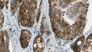 ATP12A Antibody - 1:100 staining human prostate tissue by IHC-P. The sample was formaldehyde fixed and a heat mediated antigen retrieval step in citrate buffer was performed. The sample was then blocked and incubated with the antibody for 1.5 hours at 22°C. An HRP conjugated goat anti-rabbit antibody was used as the secondary.