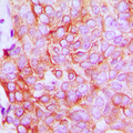 ATP1A1 Antibody - Immunohistochemical analysis of ATP1A1 staining in human breast cancer formalin fixed paraffin embedded tissue section. The section was pre-treated using heat mediated antigen retrieval with sodium citrate buffer (pH 6.0). The section was then incubated with the antibody at room temperature and detected using an HRP conjugated compact polymer system. DAB was used as the chromogen. The section was then counterstained with hematoxylin and mounted with DPX. w