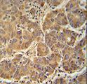 ATP5D Antibody - ATP5D antibody immunohistochemistry of formalin-fixed and paraffin-embedded human hepatocarcinoma followed by peroxidase-conjugated secondary antibody and DAB staining.