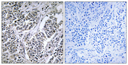 ATP5D Antibody - Immunohistochemistry analysis of paraffin-embedded human lung carcinoma tissue, using ATP5D Antibody. The picture on the right is blocked with the synthesized peptide.