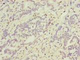 ATP5D Antibody - Immunohistochemistry of paraffin-embedded human lung cancer at dilution of 1:100
