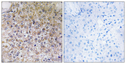 ATP6V1B1 Antibody - Immunohistochemistry analysis of paraffin-embedded human breast carcinoma tissue, using ATP6V1B1 Antibody. The picture on the right is blocked with the synthesized peptide.