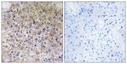 ATP6V1B1 Antibody - Peptide - + Immunohistochemistry analysis of paraffin-embedded human breast carcinoma tissue, using ATP6V1B1 antibody.