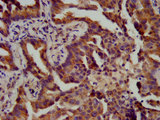 ATPAF1 Antibody - Immunohistochemistry image at a dilution of 1:400 and staining in paraffin-embedded human lung cancer performed on a Leica BondTM system. After dewaxing and hydration, antigen retrieval was mediated by high pressure in a citrate buffer (pH 6.0) . Section was blocked with 10% normal goat serum 30min at RT. Then primary antibody (1% BSA) was incubated at 4 °C overnight. The primary is detected by a biotinylated secondary antibody and visualized using an HRP conjugated SP system.