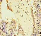 ATR Antibody - Immunohistochemistry of paraffin-embedded human lung cancer at dilution of 1:100