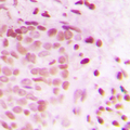 ATRIP Antibody - Immunohistochemical analysis of ATRIP staining in human breast cancer formalin fixed paraffin embedded tissue section. The section was pre-treated using heat mediated antigen retrieval with sodium citrate buffer (pH 6.0). The section was then incubated with the antibody at room temperature and detected using an HRP conjugated compact polymer system. DAB was used as the chromogen. The section was then counterstained with hematoxylin and mounted with DPX.