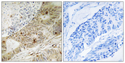 ATRIP Antibody - Immunohistochemistry analysis of paraffin-embedded human colon carcinoma, using ATRIP (Phospho-Ser224) Antibody. The picture on the right is blocked with the phospho peptide.