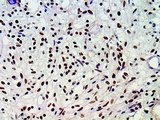 ATRX Antibody - IHC of ATRX on a FFPE Astrocytoma Tissue