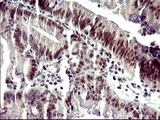 ATXN7L1 Antibody - IHC of paraffin-embedded Carcinoma of Human pancreas tissue using anti-ATXN7L1 mouse monoclonal antibody. (Heat-induced epitope retrieval by 10mM citric buffer, pH6.0, 120°C for 3min).