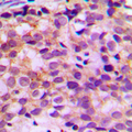 ATXN7L1 Antibody - Immunohistochemical analysis of Ataxin 7L1 staining in human breast cancer formalin fixed paraffin embedded tissue section. The section was pre-treated using heat mediated antigen retrieval with sodium citrate buffer (pH 6.0). The section was then incubated with the antibody at room temperature and detected using an HRP conjugated compact polymer system. DAB was used as the chromogen. The section was then counterstained with hematoxylin and mounted with DPX. w