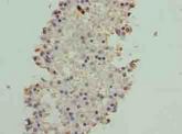 ATXN7L1 Antibody - Immunohistochemistry of paraffin-embedded human breast cancer using antibody at dilution of 1:100.