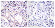AURKA / Aurora-A Antibody - Immunohistochemistry analysis of paraffin-embedded human breast carcinoma, using Aurora Kinase (Phospho-Thr288) Antibody. The picture on the right is blocked with the phospho peptide.