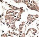 AUTL1 / ATG4C Antibody - Formalin-fixed and paraffin-embedded human cancer tissue reacted with the primary antibody, which was peroxidase-conjugated to the secondary antibody, followed by AEC staining. This data demonstrates the use of this antibody for immunohistochemistry; clinical relevance has not been evaluated. BC = breast carcinoma; HC = hepatocarcinoma.
