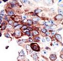 AXL Antibody - Formalin-fixed and paraffin-embedded human cancer tissue reacted with the primary antibody, which was peroxidase-conjugated to the secondary antibody, followed by DAB staining. This data demonstrates the use of this antibody for immunohistochemistry; clinical relevance has not been evaluated. BC = breast carcinoma; HC = hepatocarcinoma.