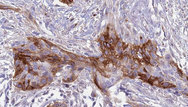 B4GALT1 Antibody - 1:100 staining human urothelial carcinoma tissue by IHC-P. The sample was formaldehyde fixed and a heat mediated antigen retrieval step in citrate buffer was performed. The sample was then blocked and incubated with the antibody for 1.5 hours at 22°C. An HRP conjugated goat anti-rabbit antibody was used as the secondary.