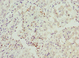 BAAT / BAT Antibody - Immunohistochemistry of paraffin-embedded human lung cancer at dilution 1:100