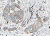 BAD Antibody - 1:100 staining human breast carcinoma tissue by IHC-P. The tissue was formaldehyde fixed and a heat mediated antigen retrieval step in citrate buffer was performed. The tissue was then blocked and incubated with the antibody for 1.5 hours at 22°C. An HRP conjugated goat anti-rabbit antibody was used as the secondary.