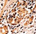 BAD Antibody - Formalin-fixed and paraffin-embedded human cancer tissue reacted with the primary antibody, which was peroxidase-conjugated to the secondary antibody, followed by AEC staining. This data demonstrates the use of this antibody for immunohistochemistry; clinical relevance has not been evaluated. BC = breast carcinoma; HC = hepatocarcinoma.