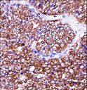 BAG2 Antibody - BAG2 Antibody immunohistochemistry of formalin-fixed and paraffin-embedded human ovarian carcinoma followed by peroxidase-conjugated secondary antibody and DAB staining.