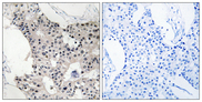 BAGE4 Antibody - Immunohistochemistry analysis of paraffin-embedded human breast carcinoma, using BAGE4 Antibody. The picture on the right is blocked with the synthesized peptide.