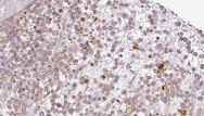 BAMBI Antibody - 1:100 staining human lymph carcinoma tissue by IHC-P. The sample was formaldehyde fixed and a heat mediated antigen retrieval step in citrate buffer was performed. The sample was then blocked and incubated with the antibody for 1.5 hours at 22°C. An HRP conjugated goat anti-rabbit antibody was used as the secondary.