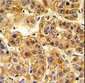 BAP / SIL1 Antibody - Formalin-fixed and paraffin-embedded human hepatocarcinoma reacted with SIL1 Antibody , which was peroxidase-conjugated to the secondary antibody, followed by DAB staining. This data demonstrates the use of this antibody for immunohistochemistry; clinical relevance has not been evaluated.
