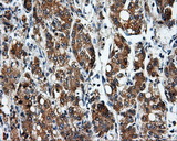 BAP / SIL1 Antibody - IHC of paraffin-embedded Carcinoma of liver tissue using anti-SIL1 mouse monoclonal antibody. (Dilution 1:50).