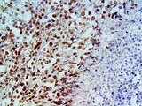 BAP1 Antibody - IHC of BAP1 on a FFPE Mesothelioma Tissue