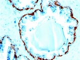 Basic Cytokeratin Antibody - Formalin-fixed, paraffin-embedded human prostate carcinoma stained with Basic Cytokeratin antibody (SPM591).  This image was taken for the unmodified form of this product. Other forms have not been tested.