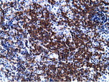 BCAP / PIK3AP1 Antibody - IHC of paraffin-embedded Human lymphoma tissue using anti-PIK3AP1 mouse monoclonal antibody.