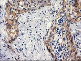 BCAR1 / p130Cas Antibody - IHC of paraffin-embedded Carcinoma of Human pancreas tissue using anti-BCAR1 mouse monoclonal antibody.