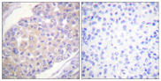 BCAR1 / p130Cas Antibody - Immunohistochemistry analysis of paraffin-embedded human breast carcinoma, using p130 Cas (Phospho-Tyr165) Antibody. The picture on the right is blocked with the phospho peptide.
