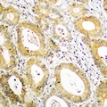 BCAR3 Antibody - Immunohistochemical analysis of BCAR3 staining in human colon cancer formalin fixed paraffin embedded tissue section. The section was pre-treated using heat mediated antigen retrieval with sodium citrate buffer (pH 6.0). The section was then incubated with the antibody at room temperature and detected using an HRP polymer system. DAB was used as the chromogen. The section was then counterstained with hematoxylin and mounted with DPX.