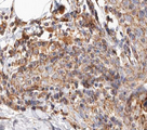 BCAR3 Antibody - 1:100 staining human breast carcinoma tissue by IHC-P. The tissue was formaldehyde fixed and a heat mediated antigen retrieval step in citrate buffer was performed. The tissue was then blocked and incubated with the antibody for 1.5 hours at 22°C. An HRP conjugated goat anti-rabbit antibody was used as the secondary.