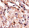 BCKDK Antibody - Formalin-fixed and paraffin-embedded human cancer tissue reacted with the primary antibody, which was peroxidase-conjugated to the secondary antibody, followed by AEC staining. This data demonstrates the use of this antibody for immunohistochemistry; clinical relevance has not been evaluated. BC = breast carcinoma; HC = hepatocarcinoma.