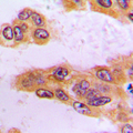 BCKDK Antibody - Immunohistochemical analysis of BCKDK staining in human liver cancer formalin fixed paraffin embedded tissue section. The section was pre-treated using heat mediated antigen retrieval with sodium citrate buffer (pH 6.0). The section was then incubated with the antibody at room temperature and detected using an HRP conjugated compact polymer system. DAB was used as the chromogen. The section was then counterstained with hematoxylin and mounted with DPX.