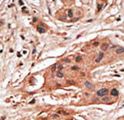 BCL2A1 Antibody - Formalin-fixed and paraffin-embedded human cancer tissue reacted with the primary antibody, which was peroxidase-conjugated to the secondary antibody, followed by DAB staining. This data demonstrates the use of this antibody for immunohistochemistry; clinical relevance has not been evaluated. BC = breast carcinoma; HC = hepatocarcinoma.