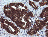 BCL2L1 / BCL-XL Antibody - IHC of paraffin-embedded Carcinoma of Human prostate tissue using anti-BCL2L1 mouse monoclonal antibody.
